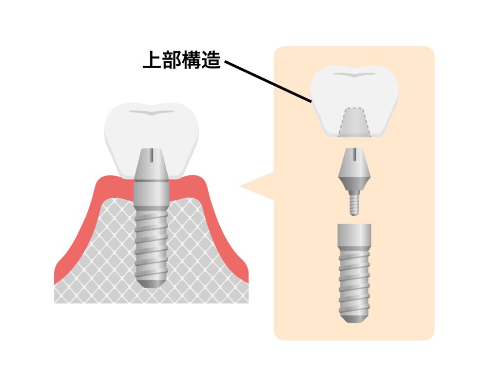 上部構造(人工歯)