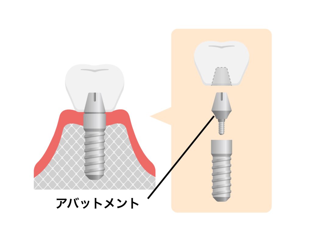 アバットメント
